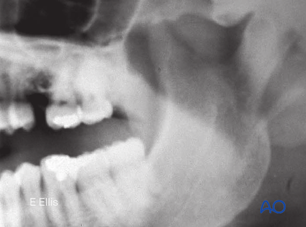 Panoramic x-ray taken at 6 weeks shows continued alignment of the condylar process fracture.