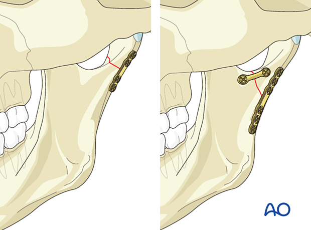 If possible, two plates should ideally be used in all condylar fractures