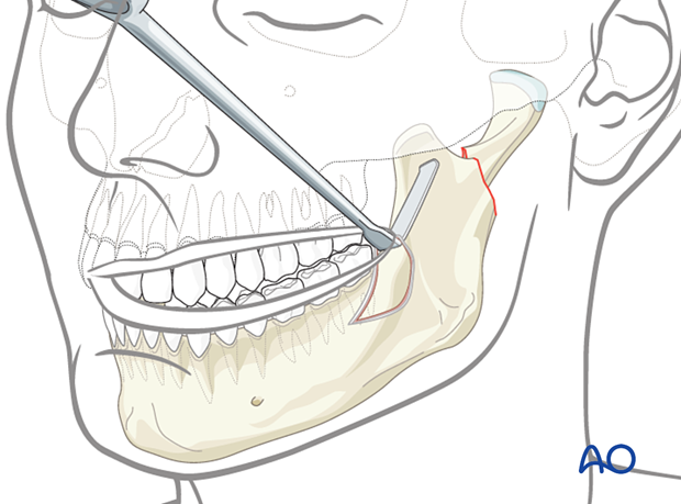 Some surgeons find the combination retractor too bulky in some settings and prefer to use a  large Langenbeck type 