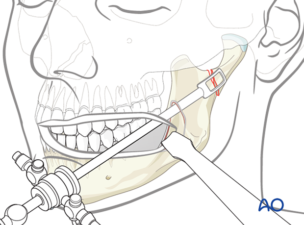 Some surgeons use a sturdy endoscope sheath with a spatula-shaped tip and a central opening to maintain the cavity. 