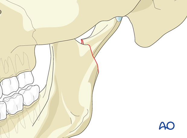 Conversion of a medial override to a lateral override