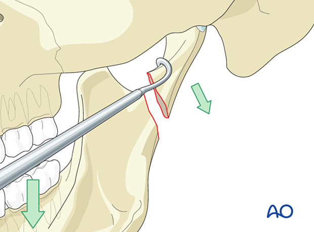 Forcefully and fully distract the fracture by manually applying downward pressure on the posterior mandibular dentition while simultaneously applying lateral pressure on the condylar fragment with the elevator