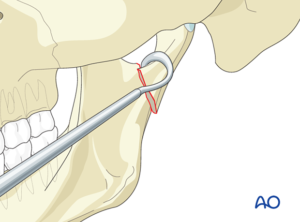 The medially displaced condylar fragment will now be resting on the ascending ramus's lateral surface, effectively converting it into a simpler lateral displaced fracture