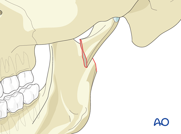 It is advantageous if the condylar fragment is already displaced laterally (lateral override). 