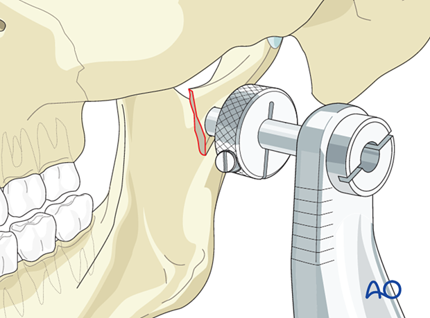 Insert the transbuccal system approximately over the palpated fracture line at the posterior border of the mandible. 