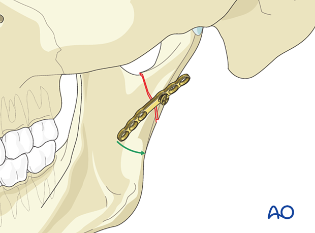 Rotate the plate to align it with the posterior border of the condylar fragment.