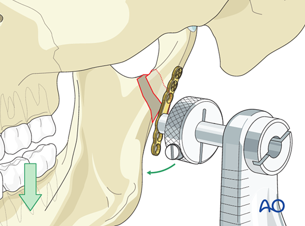 Apply downward pressure on the posterior dentition to distract the fracture while simultaneously using the end of the plate as a handle to manipulate the condylar fragment into reduction. 