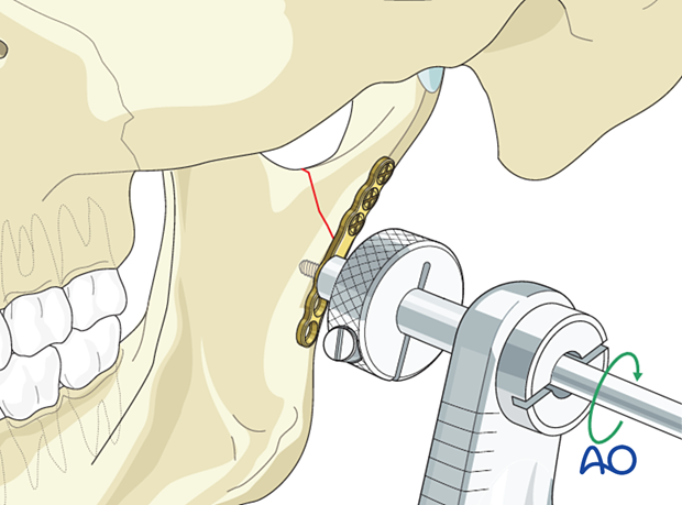 Insertion of the first screw in the mandibular segment