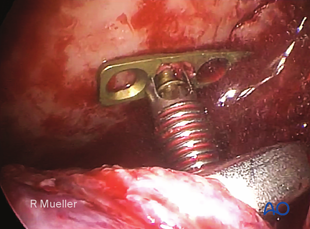 This clinical image shows the insertion of the first screw in the mandibular segment. 