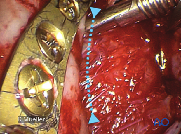 91 P750 C orif endoscopically assisted