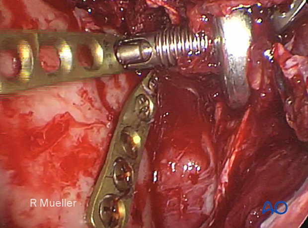 This image shows an endoscopic view of a second anterior plate being positioned using the cheek trochar and drill guide