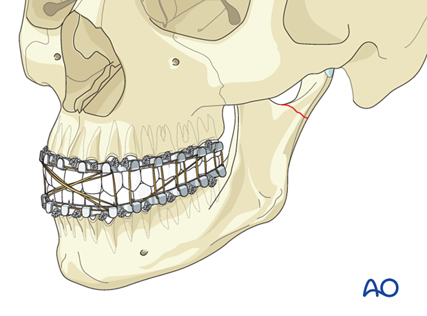 Open reduction and stable internal fixation in dentate patients begins with fixation of the occlusion. 