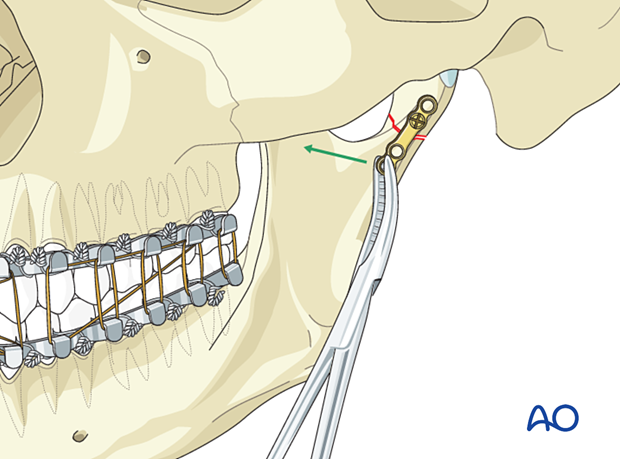 The fracture is reduced, and the plate is manipulated to ensure that all four screws can be inserted in secure bone.