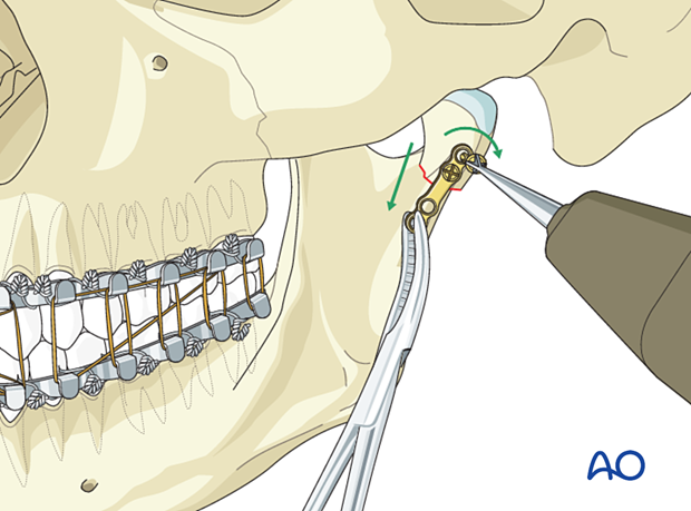 The bone plate is then used to distract the condyle inferior and laterally