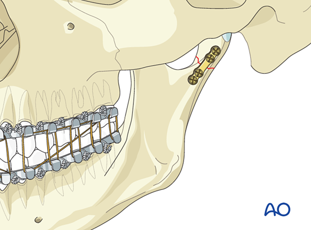 The condylar fragment is then reduced and the screws below the fracture are inserted.