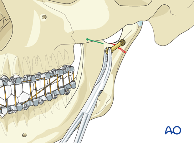 In order to align the posterior border, pull traction on the small plate with a clamp (illustrated) or an angled hook.