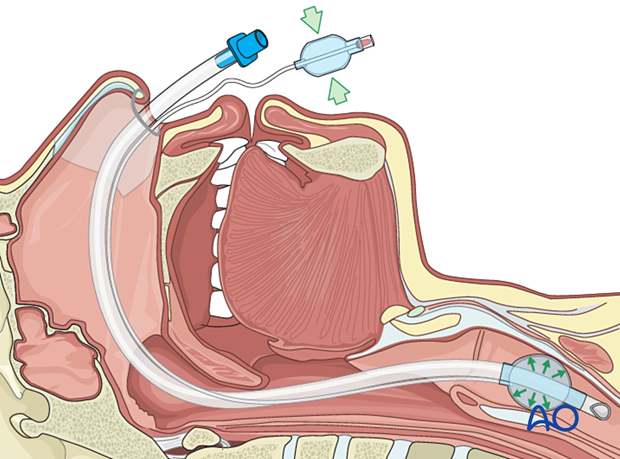 Nasotracheal intubation