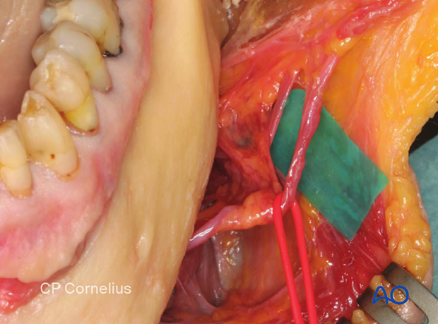 The facial vessels cross the mandible's inferior border at the level corresponding to the anterior border of the masseter muscle