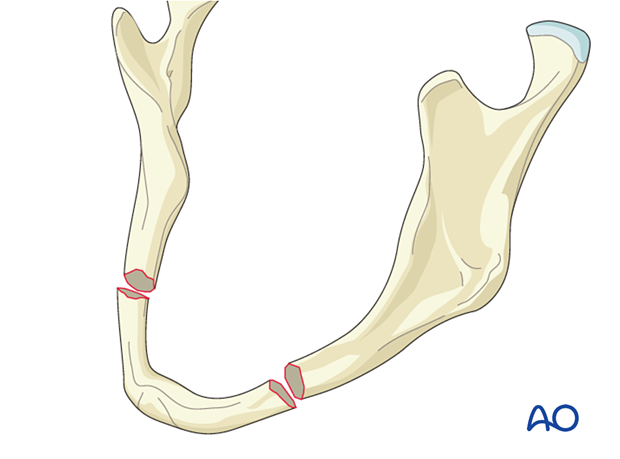 Fractured mandible