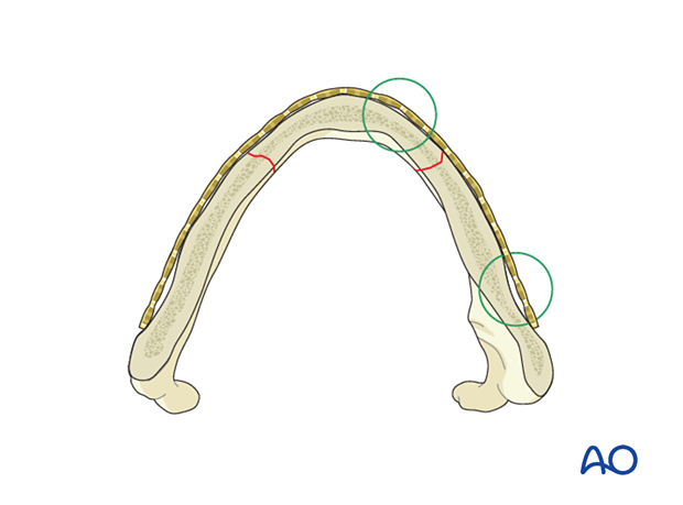 Plate adaptation