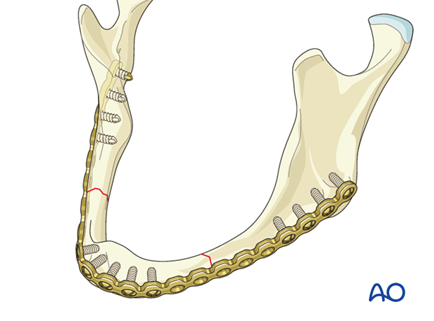 Reconstruction plate applied to edentulous atropich mandible