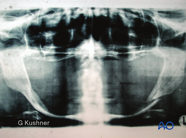 X-ray of edentulous atropic fracture