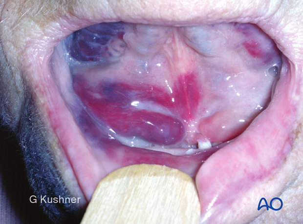 The patient shows intraoral ecchymosis in the floor of the mouth associated with an atrophic edentulous mandible fracture.