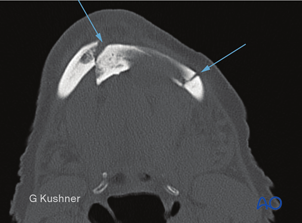 Axial CT scan showing bilateral fractures.