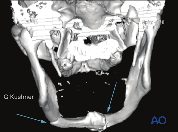 This image is a 3D reconstruction of the same case.