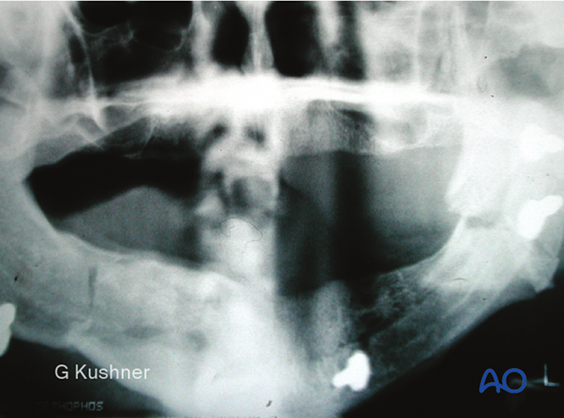 X-ray of fractured mandible