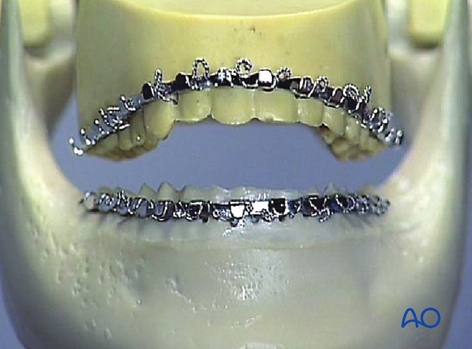 Arch bars wired around the upper and lower teeth of a model jaw