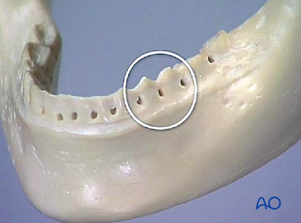 When possible, the premolars are used in the maxilla and mandible.
