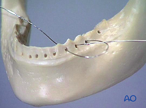 Pass the other end between the first premolar and canine (nr.4 and nr. 3).