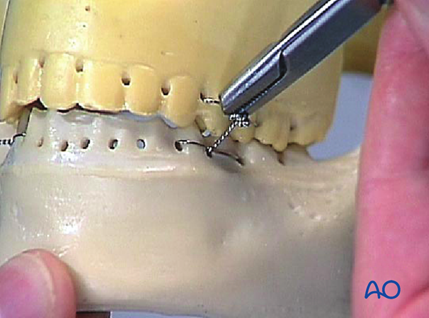 Cut the wire ends and bend them towards the teeth to protect the oral mucosa and the operator from accidental injuries.