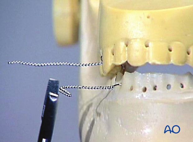 To accommodate elastics, bend together the wire ends …