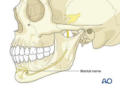 Mandibulomaxillary fixation (MMF) - Bone supported devices