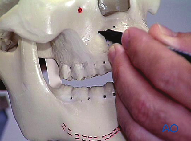 Correct screw placement in the maxilla