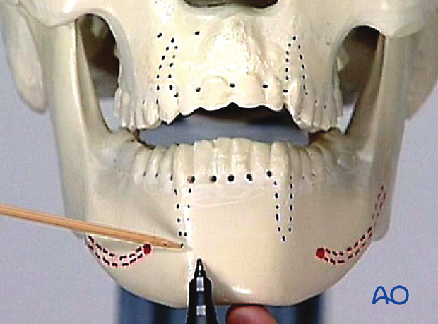 Correct screw placement in the mandible