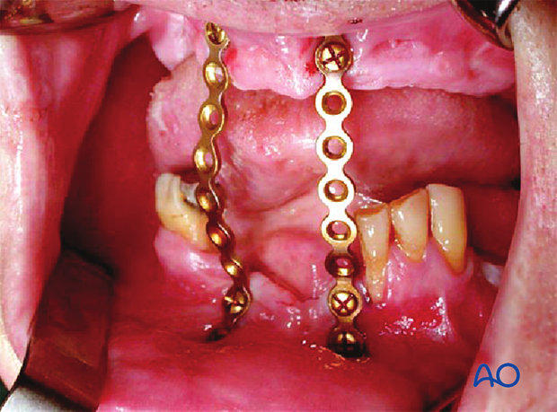 Implementation in edentulous mandible