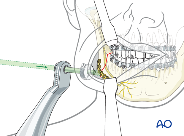 Use of the transbuccal system