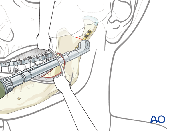 Use of the angulated screwdriver for fixation of a condylar fragment