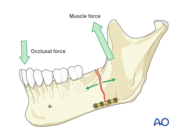 This illustration demonstrates the biomechanics of an angle fracture