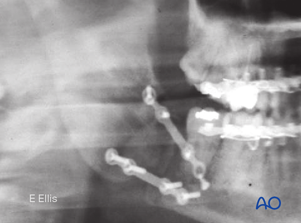 X-ray shows at least one loose screw and loss of fixation