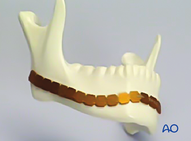 Contouring of template to fit the mandible