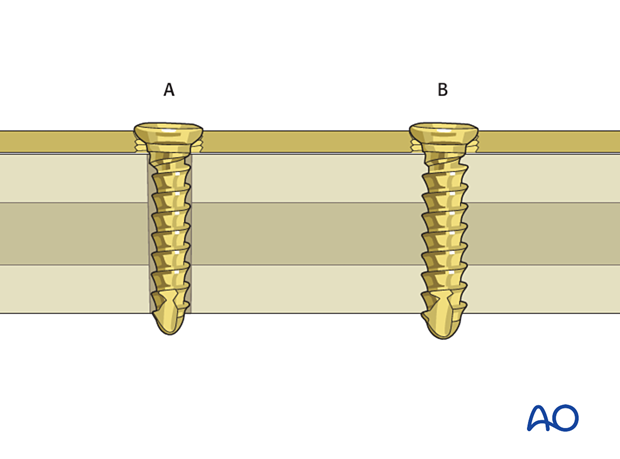 approach to the le fort i level of the midface in cleft lip and palate patients