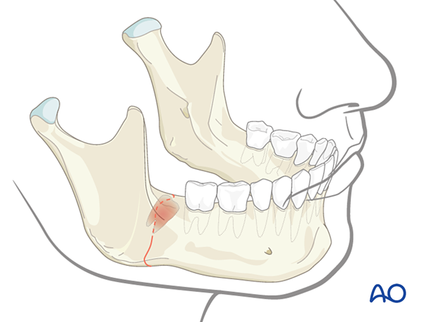 Unerupted tooth in the line of fracture