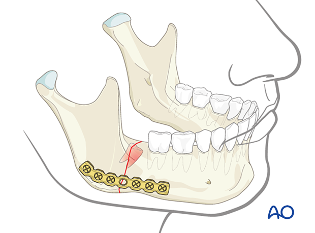 Fracture with tooth in the line of fracture fixed with reconstruction plate