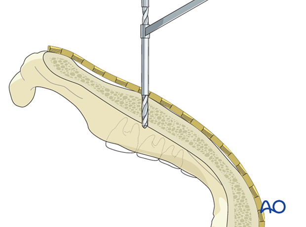 Insertion of nonlocking screws in locking screw plate