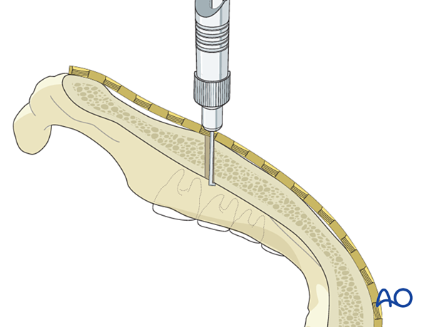 Use a depth gauge to determine the appropriate screw length for screws inserted bicortically.