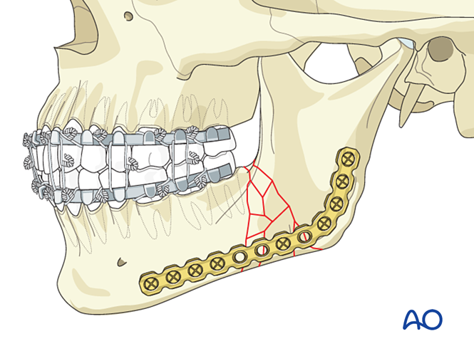 91 X070 load bearing versus load sharing